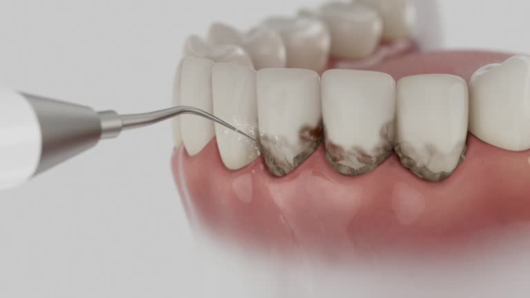 Reliable Dental Implants contractor in Bremen, OH by Smile Center Dentistry